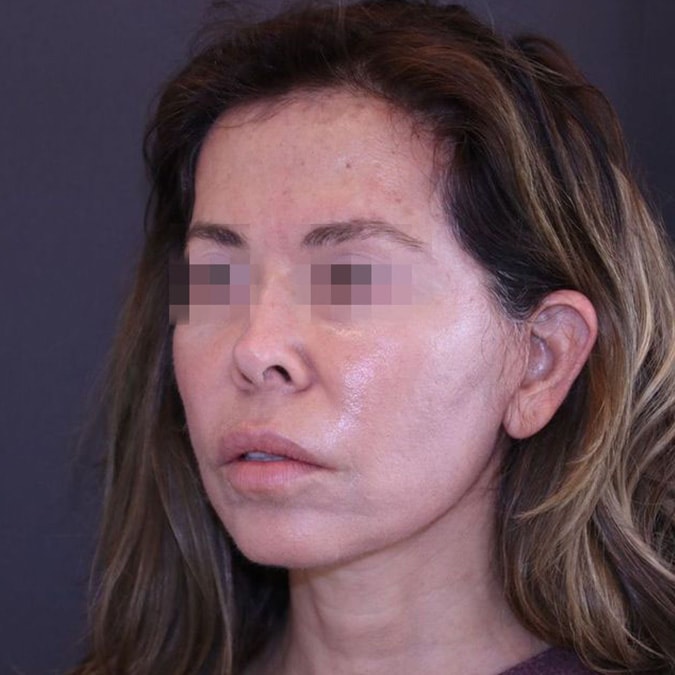 Facelift Before and After 41