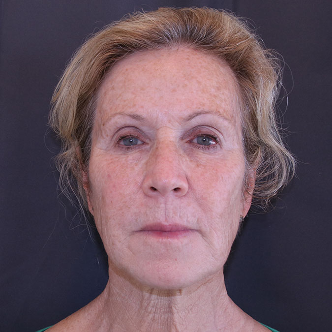 Facelift Before and After | Dr. Leslie Stevens