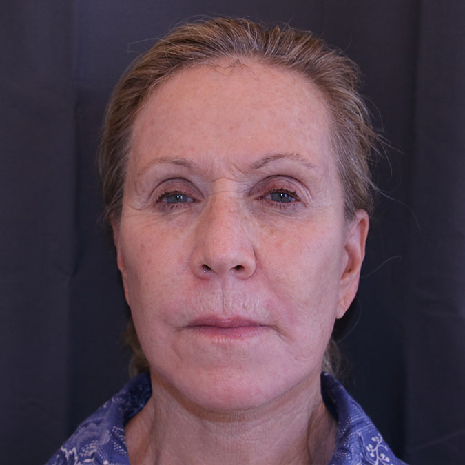 Facelift Before and After | Dr. Leslie Stevens