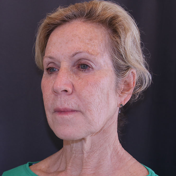 Facelift Before and After 42