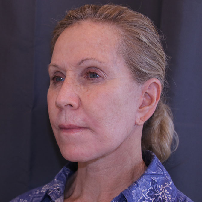 Facelift Before and After 42