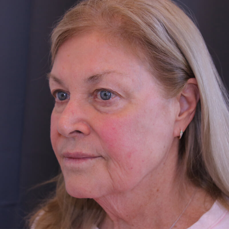 Facelift Before and After 44