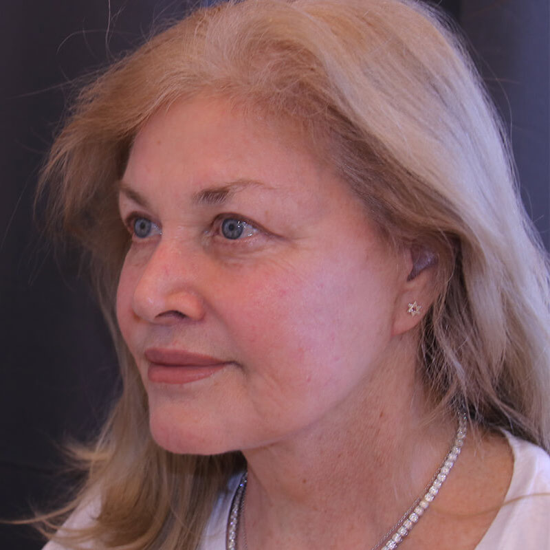 Facelift Before and After 44
