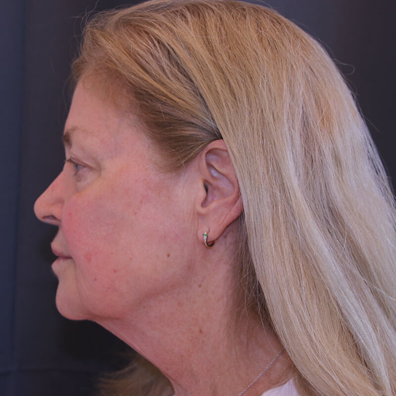 Facelift Before and After 44