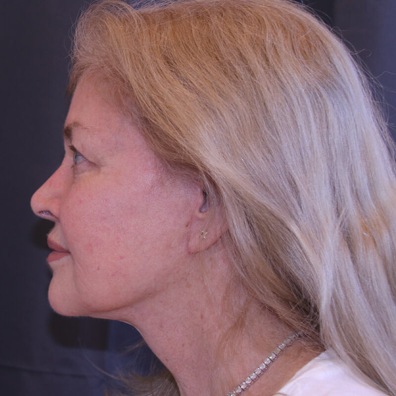 Facelift Before and After 44
