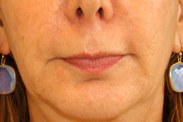 Lip Lift Before and After | Dr. Leslie Stevens
