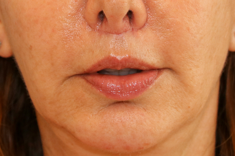 Lip Lift Before and After | Dr. Leslie Stevens