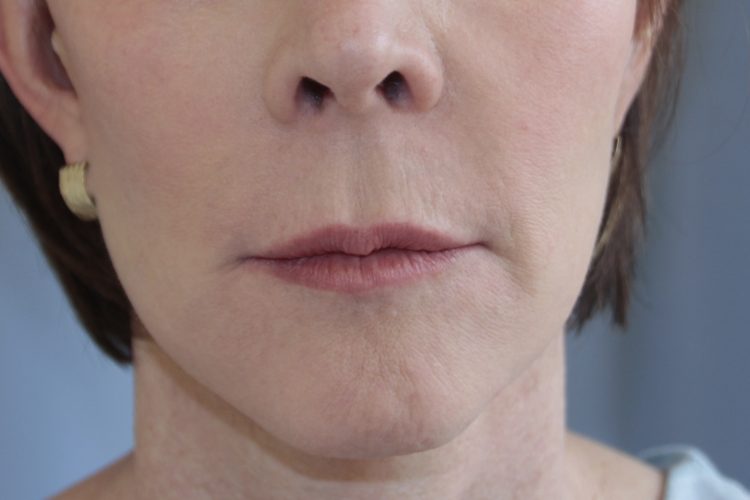 Lip Lift Before and After | Dr. Leslie Stevens