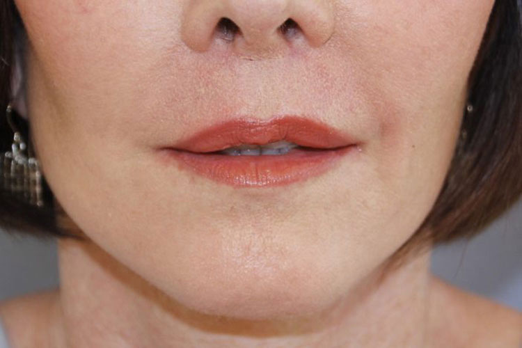 Lip Lift Before and After 11