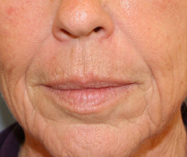 Lip Lift Before and After 04