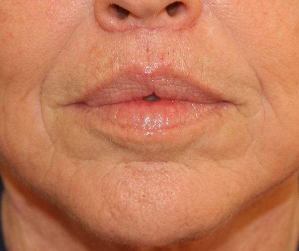 Lip Lift Before and After 01