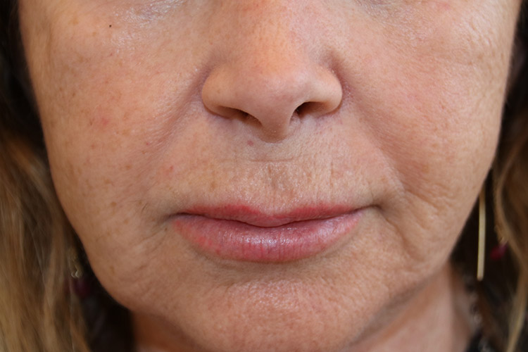 Lip Lift Before and After | Dr. Leslie Stevens