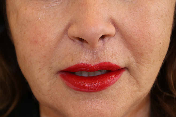 Lip Lift Before and After | Dr. Leslie Stevens