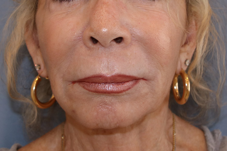 Lip Lift Before and After | Dr. Leslie Stevens