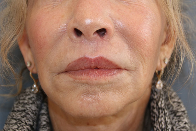 Lip Lift Before and After 03