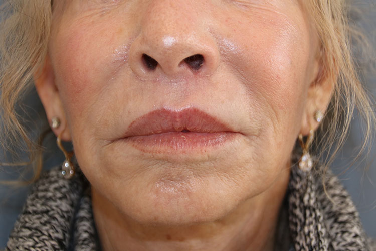 Lip Lift Before and After 10