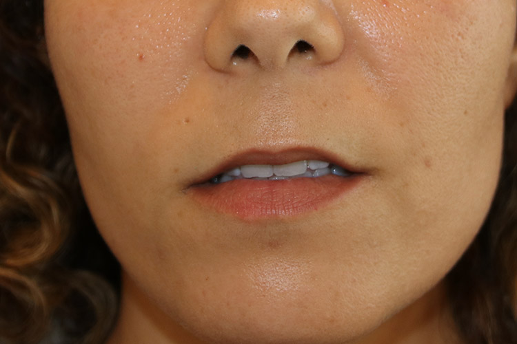 Lip Lift Before and After | Dr. Leslie Stevens