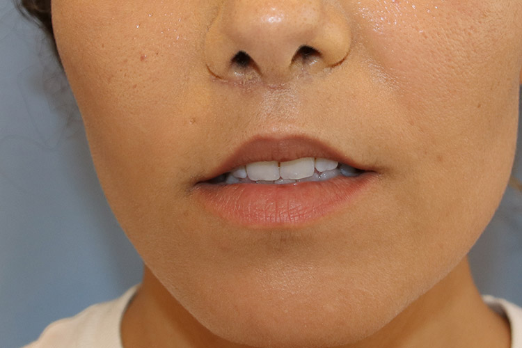 Lip Lift Before and After | Dr. Leslie Stevens