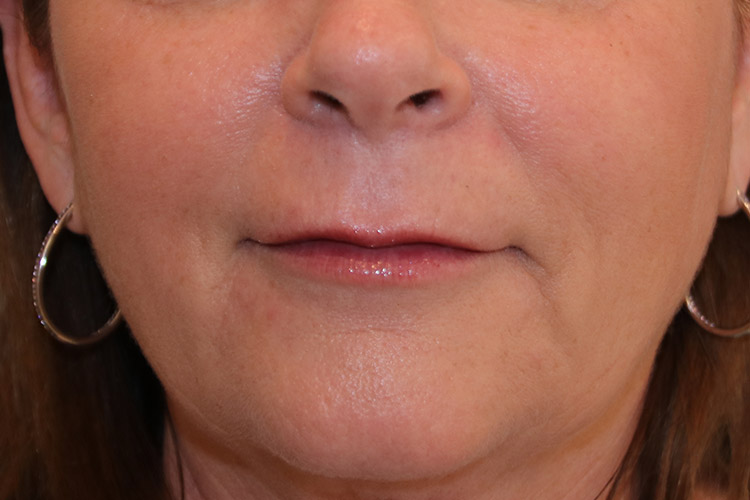 Lip Lift Before and After 08