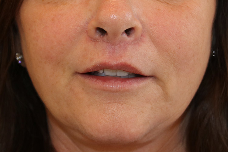 Lip Lift Before and After | Dr. Leslie Stevens