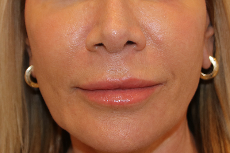 Lip Lift Before and After | Dr. Leslie Stevens