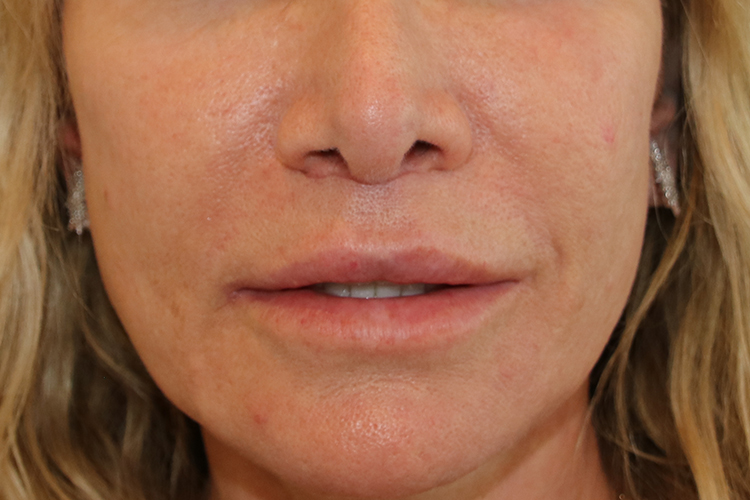 Lip Lift Before and After 03
