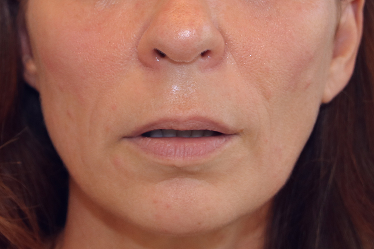 Lip Lift Before and After | Dr. Leslie Stevens