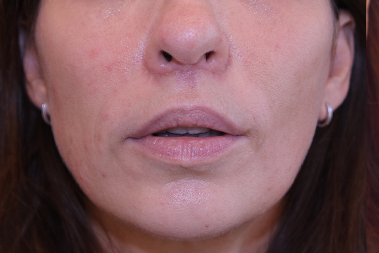 Lip Lift Before and After 13