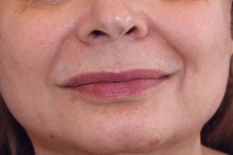 Lip Lift Before and After | Dr. Leslie Stevens