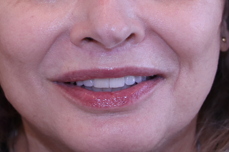 Lip Lift Before and After | Dr. Leslie Stevens