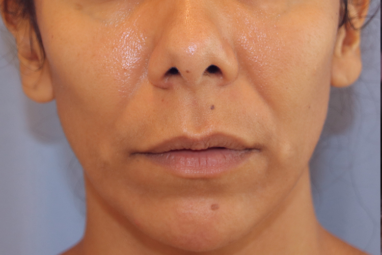 Lip Lift Before and After | Dr. Leslie Stevens