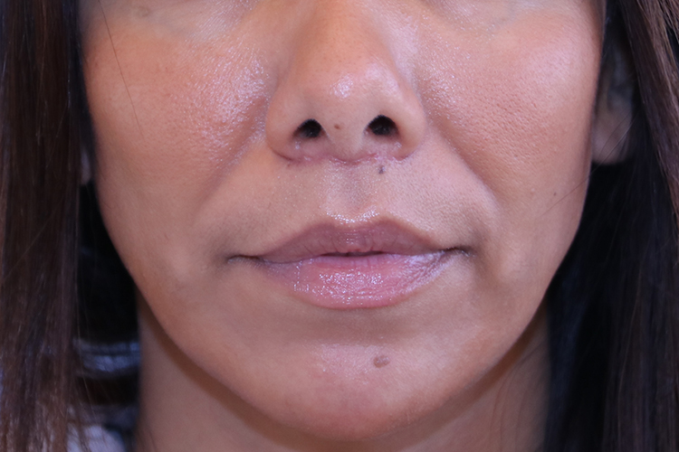 Lip Lift Before and After | Dr. Leslie Stevens