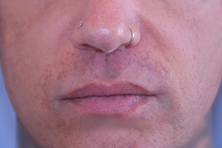 Lip Lift Before and After 13