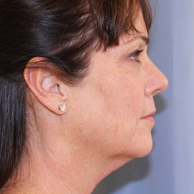 Neck Lift Before and After 01