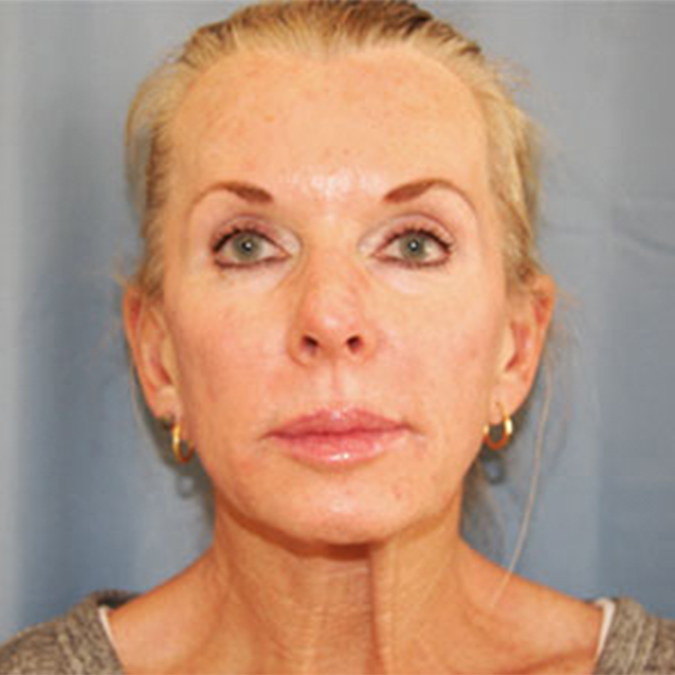 Neck Lift Before and After | Dr. Leslie Stevens