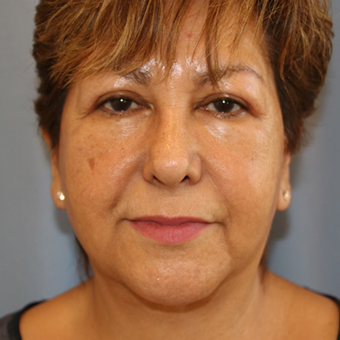 Otoplasty Before and After | Dr. Leslie Stevens