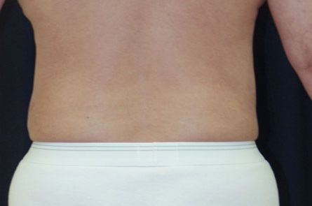 Liposuction Before and After | Dr. Leslie Stevens