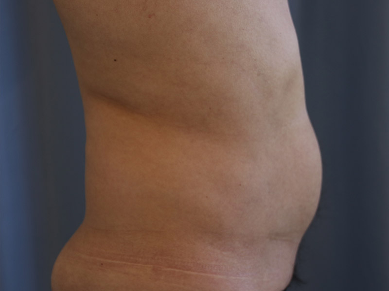 Liposuction Before and After 08