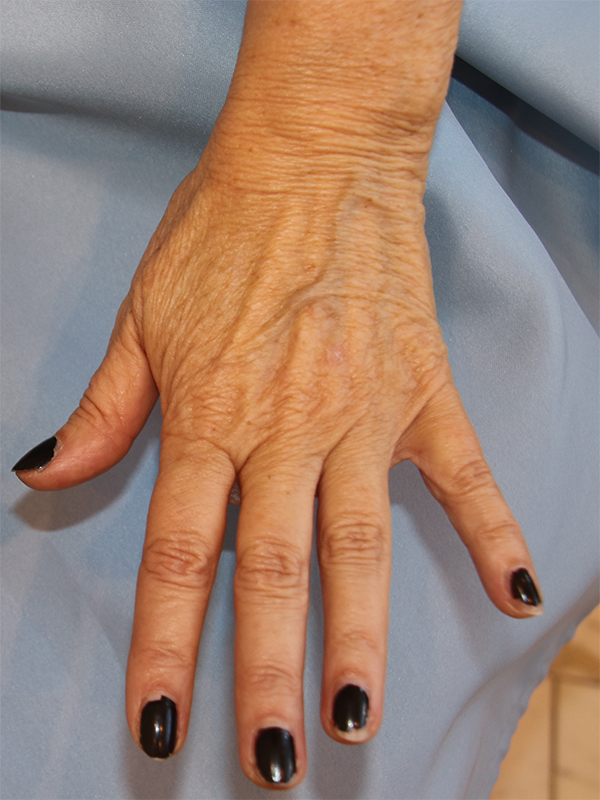 Hand Rejuvenation Before and After | Dr. Leslie Stevens