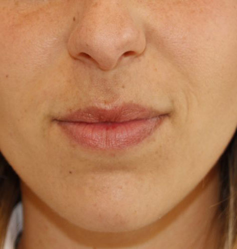 Juvederm Before and After 01