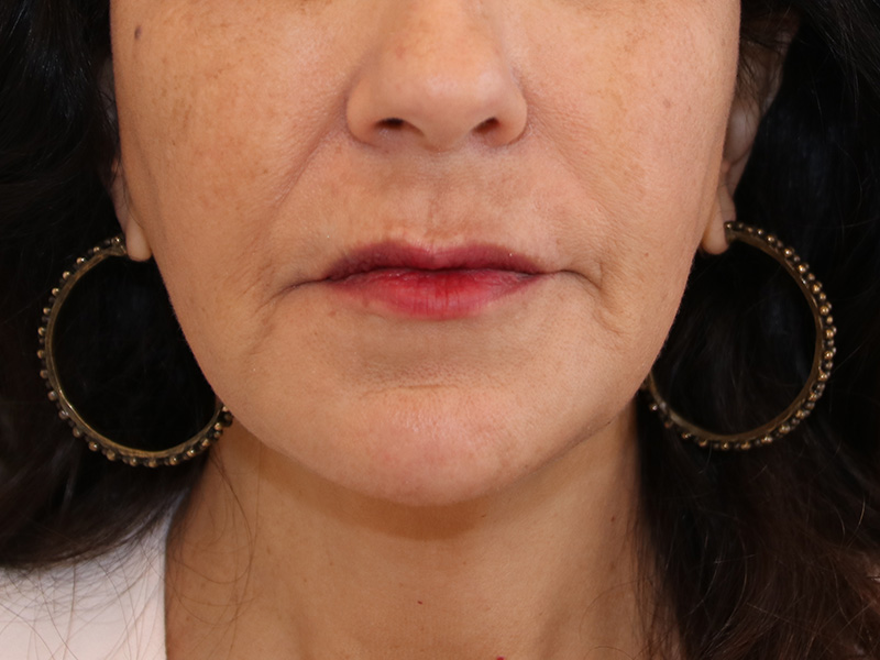 Juvederm Before and After | Dr. Leslie Stevens