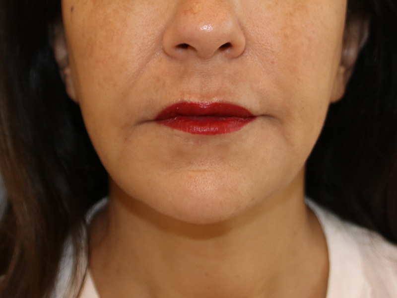 Juvederm Before and After | Dr. Leslie Stevens