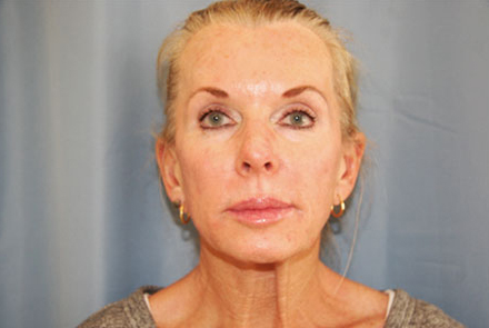 Sculptra Before and After | Dr. Leslie Stevens