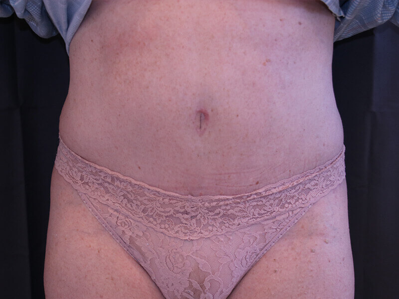 Tummy Tuck - Patient After