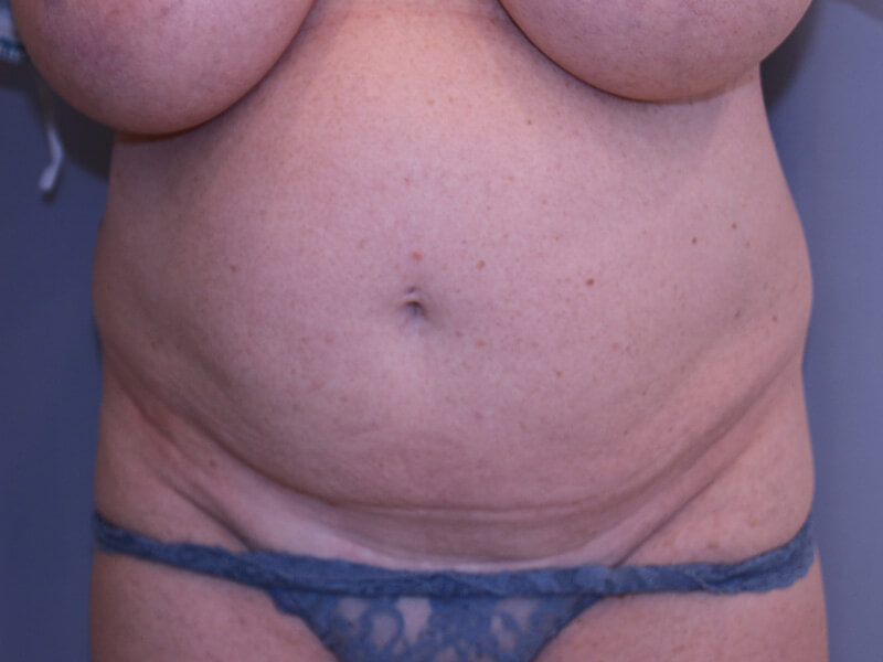 Tummy Tuck - Patient Before