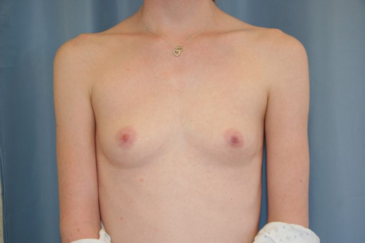 Breast Augmentation Beverly Hills Patient - Before 3
