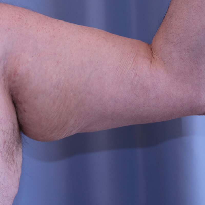 Arm Lift - Patient Before