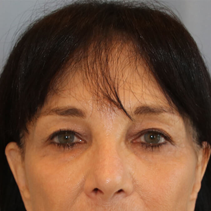 Eyelid Surgery - Patient Before