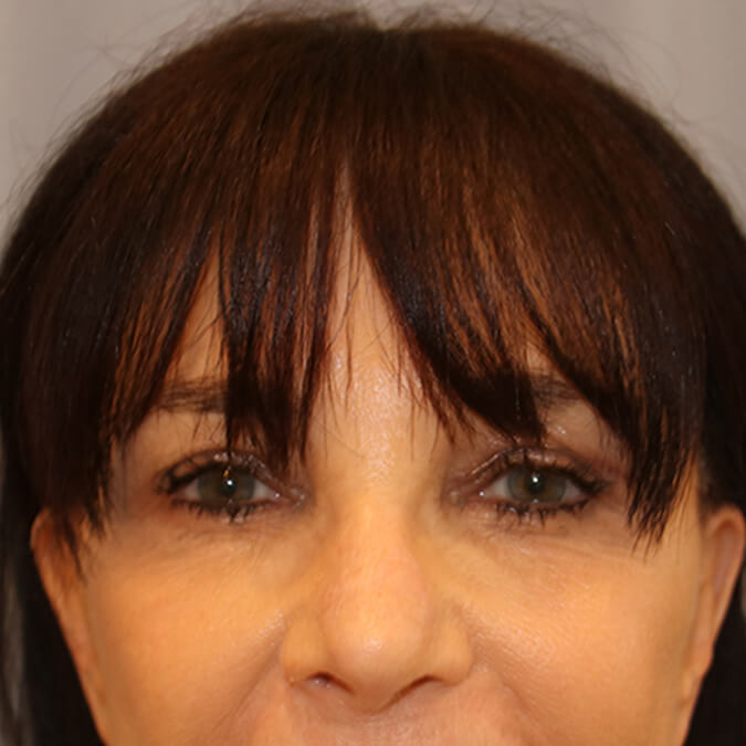 Eyelid Surgery - Patient After