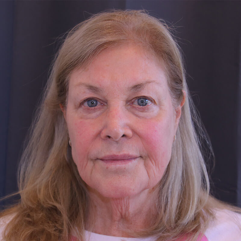 Facelift - Patient Before